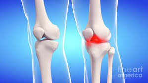 Arthritis Profile